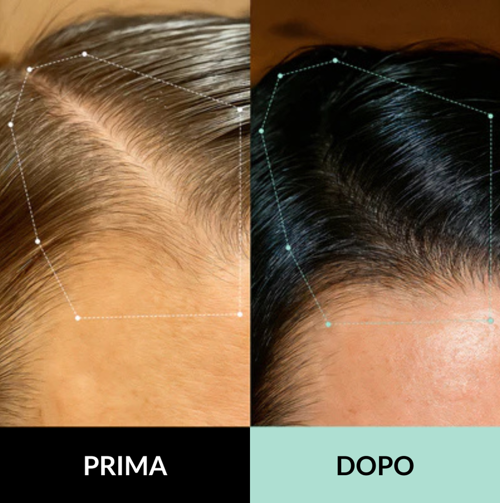 Sistema di microinfusione multi-peptidica  e adenosina per la caduta dei capelli
