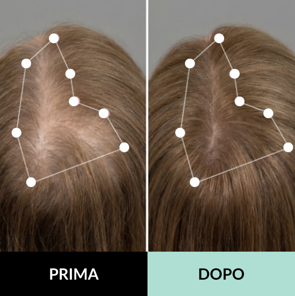 Sistema di microinfusione multi-peptidica  e adenosina per la caduta dei capelli