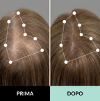 Sistema di microinfusione multi-peptidica  e adenosina per la caduta dei capelli
