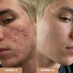 Stick Clinico per Cicatrici da Acne™