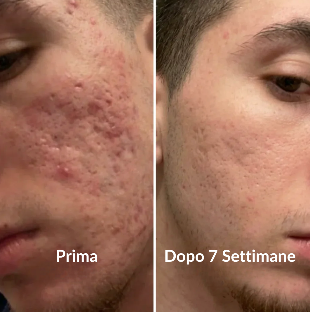 Stick Clinico per il Rimodellamento delle Cicatrici da Acne™