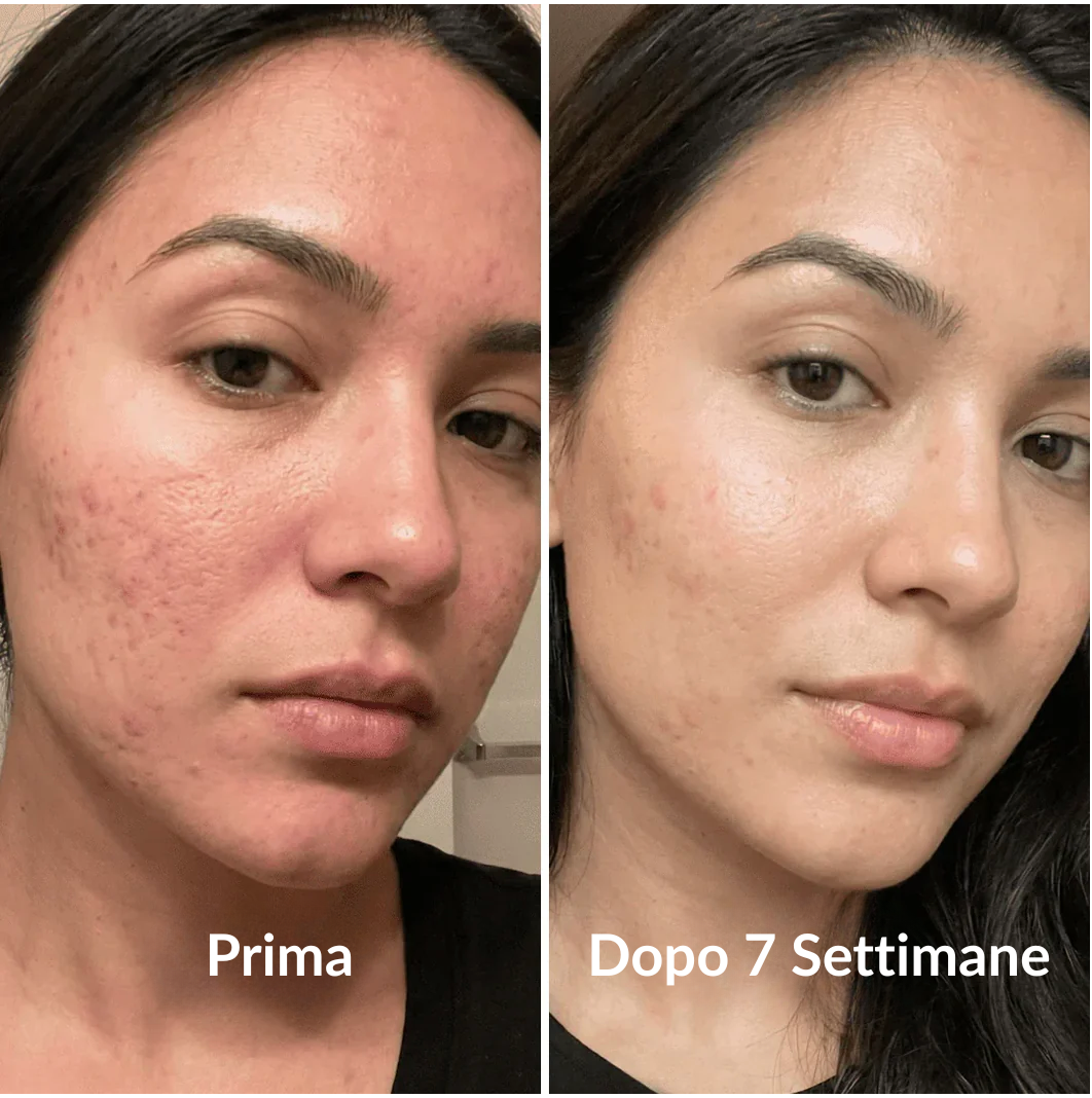 Stick Clinico per il Rimodellamento delle Cicatrici da Acne™